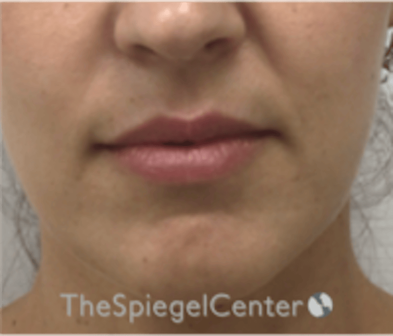 Lip Filler Before & After Gallery - Patient 344603 - Image 1