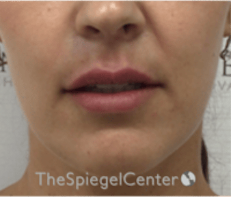 Lip Filler Before & After Gallery - Patient 344603 - Image 2