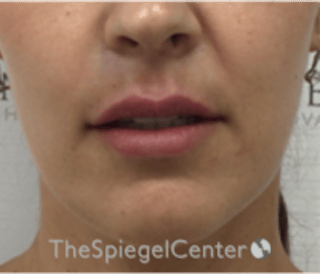 Lip Filler Before & After Gallery - Patient 344603 - Image 2