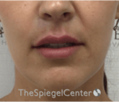 Lip Filler Before & After Gallery - Patient 344603 - Image 2