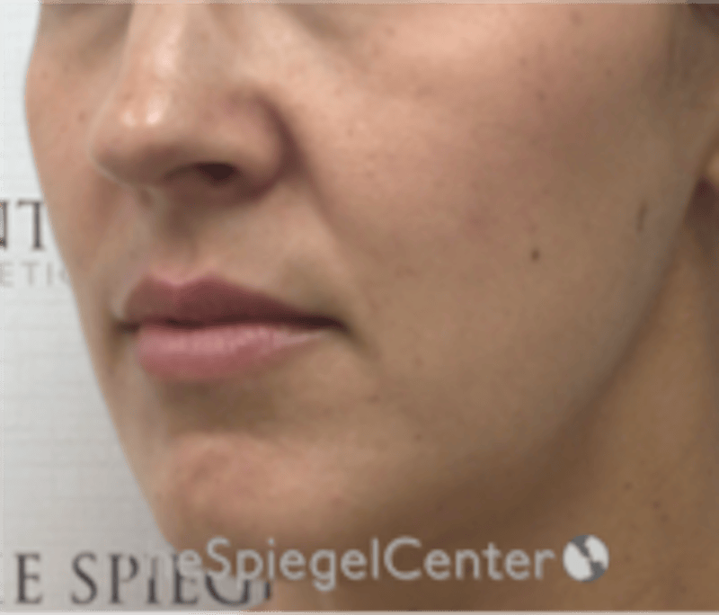 Lip Filler Before & After Gallery - Patient 344603 - Image 3