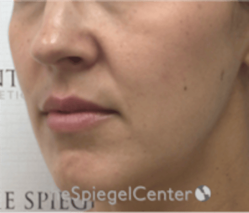 Lip Filler Before & After Gallery - Patient 344603 - Image 3