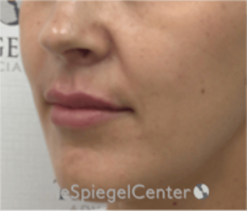 Lip Filler Before & After Gallery - Patient 344603 - Image 4