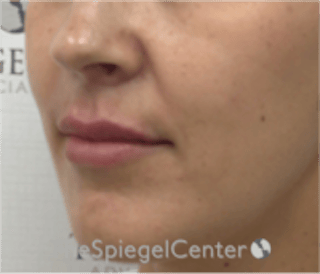 Lip Filler Before & After Gallery - Patient 344603 - Image 4