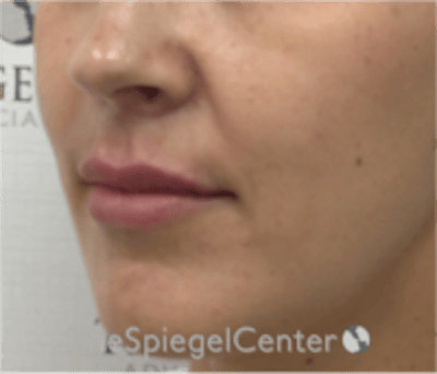 Lip Filler Before & After Gallery - Patient 344603 - Image 4