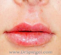 Lip Filler Before & After Gallery - Patient 197908 - Image 2