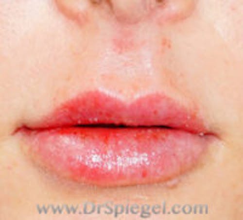 Lip Filler Before & After Gallery - Patient 197908 - Image 2