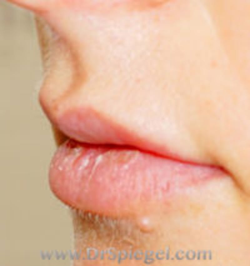 Lip Filler Before & After Gallery - Patient 197908 - Image 3
