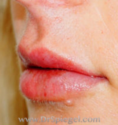 Lip Filler Before & After Gallery - Patient 197908 - Image 4