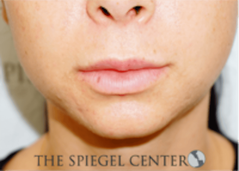 Lip Filler Before & After Gallery - Patient 688009 - Image 1
