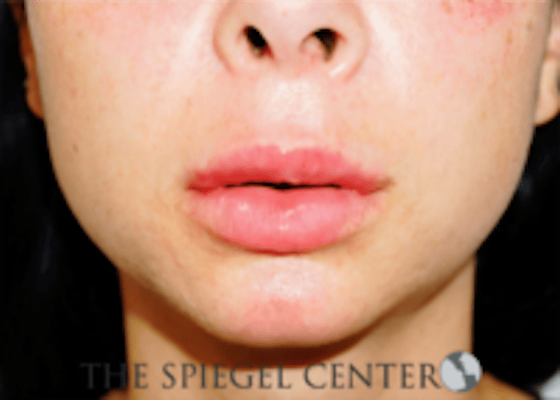 Lip Filler Before & After Gallery - Patient 688009 - Image 2