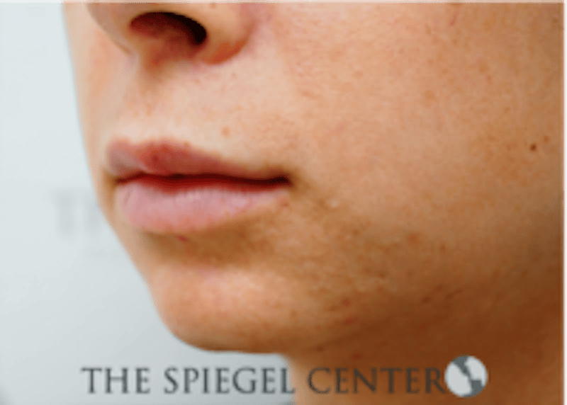 Lip Filler Before & After Gallery - Patient 688009 - Image 3