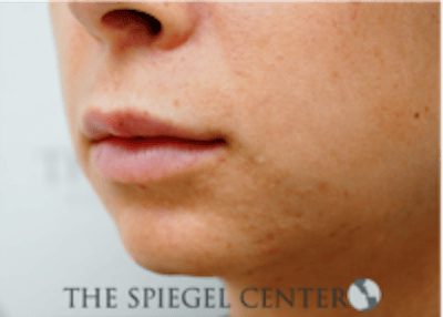 Lip Filler Before & After Gallery - Patient 688009 - Image 3