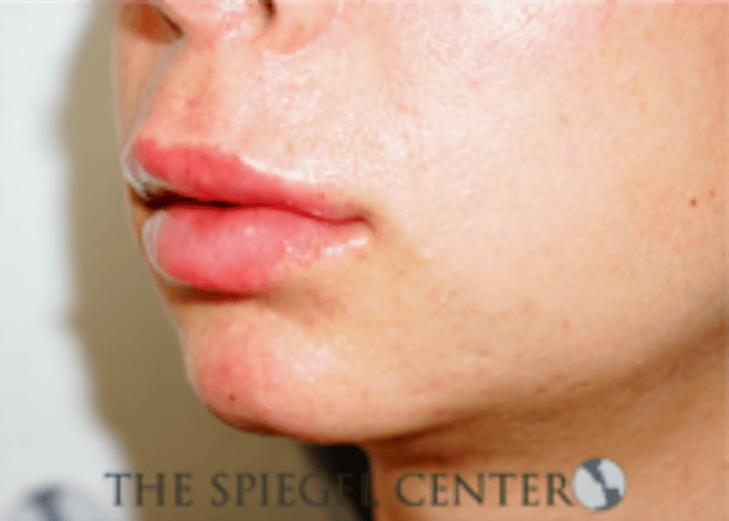 Lip Filler Before & After Gallery - Patient 688009 - Image 4