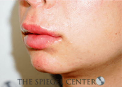 Lip Filler Before & After Gallery - Patient 688009 - Image 4