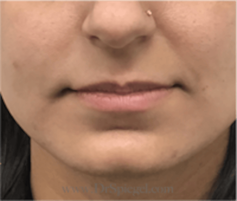 Lip Filler Before & After Gallery - Patient 315854 - Image 1