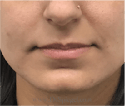 Lip Filler Before & After Gallery - Patient 315854 - Image 1