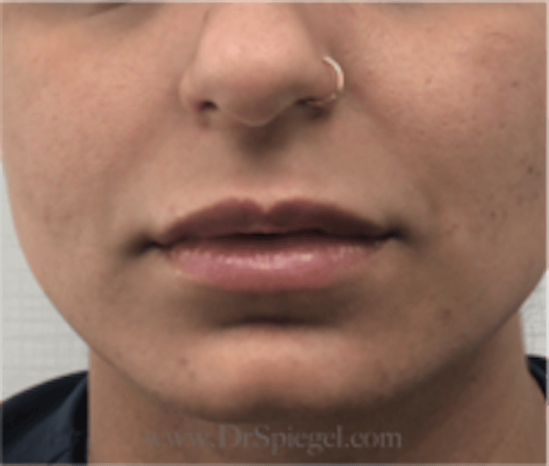 Lip Filler Before & After Gallery - Patient 315854 - Image 2