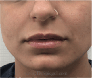 Lip Filler Before & After Gallery - Patient 315854 - Image 2