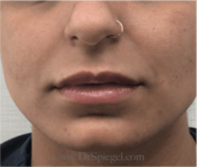 Lip Filler Before & After Gallery - Patient 315854 - Image 2