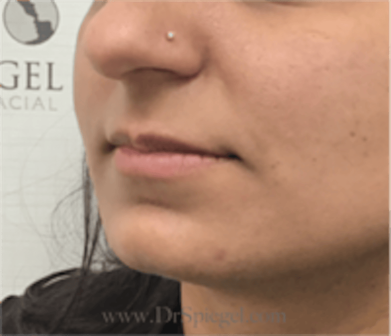 Lip Filler Before & After Gallery - Patient 315854 - Image 3