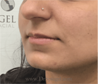 Lip Filler Before & After Gallery - Patient 315854 - Image 3