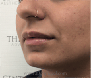 Lip Filler Before & After Gallery - Patient 315854 - Image 4