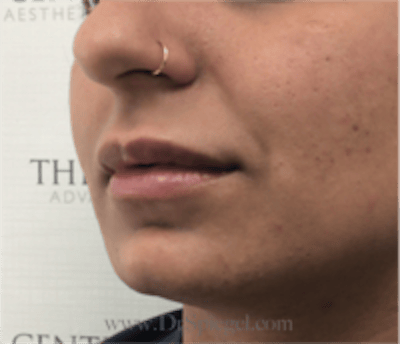 Lip Filler Before & After Gallery - Patient 315854 - Image 4