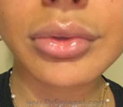 Lip Filler Before & After Gallery - Patient 115683 - Image 2