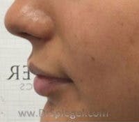 Lip Filler Before & After Gallery - Patient 115683 - Image 3