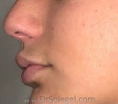 Lip Filler Before & After Gallery - Patient 115683 - Image 4