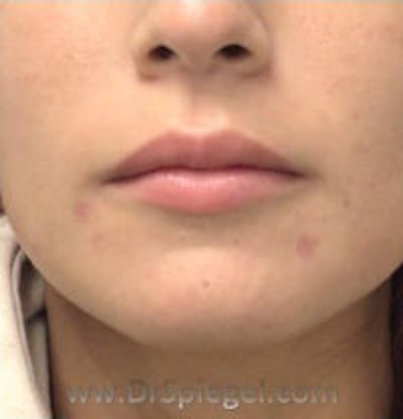 Lip Filler Before & After Gallery - Patient 622040 - Image 1