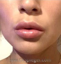 Lip Filler Before & After Gallery - Patient 622040 - Image 2