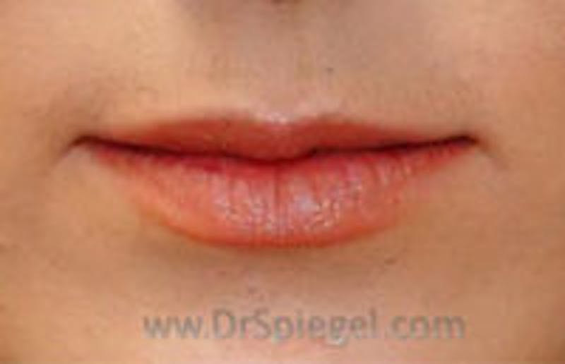 Lip Filler Before & After Gallery - Patient 259920 - Image 1