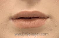 Lip Filler Before & After Gallery - Patient 259920 - Image 2