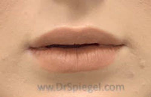 Lip Filler Before & After Gallery - Patient 259920 - Image 2