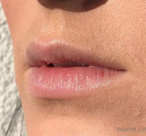 Lip Filler Before & After Gallery - Patient 259920 - Image 3