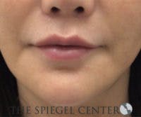 Lip Filler Before & After Gallery - Patient 558994 - Image 2