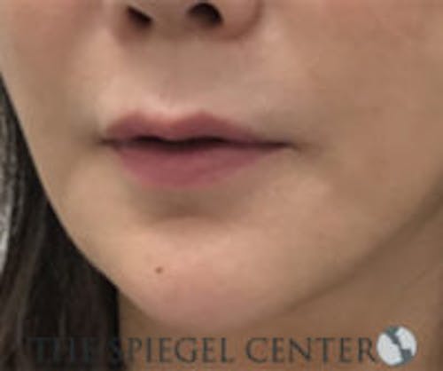 Lip Fillers Before & After Gallery - Patient 229290 - Image 3