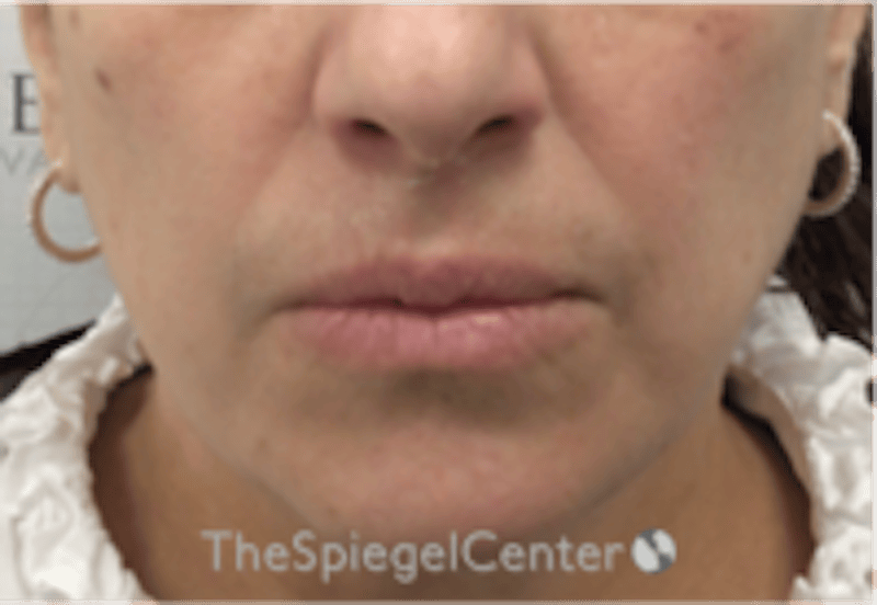 Lip Filler Before & After Gallery - Patient 281996 - Image 1