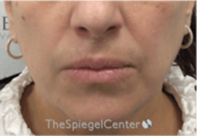 Lip Filler Before & After Gallery - Patient 281996 - Image 1