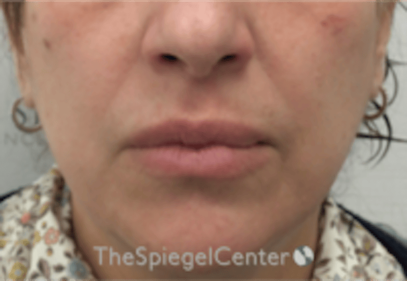 Lip Filler Before & After Gallery - Patient 281996 - Image 2