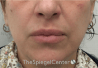 Lip Filler Before & After Gallery - Patient 281996 - Image 2