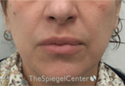 Lip Filler Before & After Gallery - Patient 281996 - Image 2
