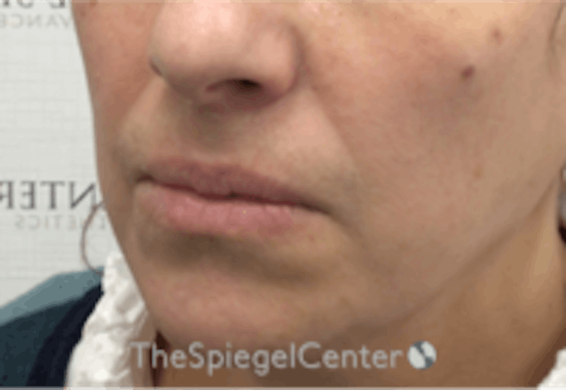 Lip Filler Before & After Gallery - Patient 281996 - Image 3