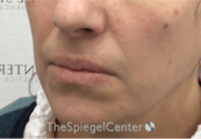 Lip Filler Before & After Gallery - Patient 281996 - Image 3