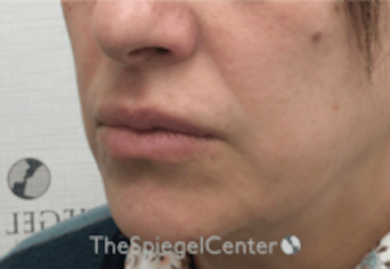 Lip Filler Before & After Gallery - Patient 281996 - Image 4