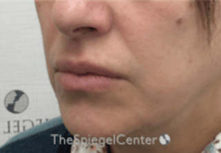 Lip Filler Before & After Gallery - Patient 281996 - Image 4
