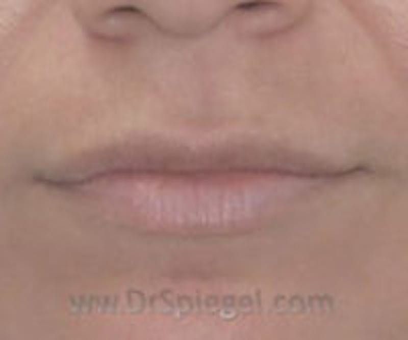 Lip Filler Before & After Gallery - Patient 407173 - Image 1
