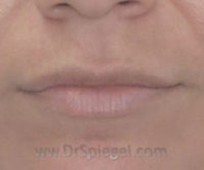 Lip Filler Before & After Gallery - Patient 407173 - Image 1